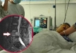 Đau lưng nên khám xương khớp, ai ngờ bị ung thư phổi “ăn mòn” 2 đốt sống