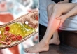 Khi tích tụ nhiều cholesterol nguy hiểm, cơ thể phát ra tín hiệu đầu tiên ở chân, bạn cần đi khám ngay nếu gặp