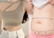 Phẫu thuật tạo hình thành bụng để có eo săn chắc, rãnh bụng sâu: 5 yếu tố tác động đến kết quả cuối cùng