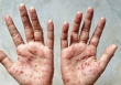 Việt Nam xuất hiện 2 ca đậu mùa khỉ chưa rõ nguồn lây, làm 6 điều để phòng bệnh