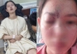 Thiếu nữ 17 tuổi mù mắt vĩnh viễn, liệt nửa não trái sau tiêm filler nâng mũi: Đừng quên 4 điều để an toàn khi làm đẹp