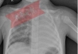 Phổi trái của bé trai 1 tuổi 'biến mất', thủ phạm bất ngờ là món ăn thường xuất hiện vào dịp Tết, phụ huynh cần cảnh giác