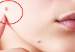 Phụ nữ bị nổi mụn cóc ở 5 vị trí này coi chừng đã nhiễm HPV, tiềm ẩn nguy cơ ung thư cổ tử cung và bệnh tình dục