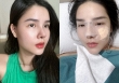 Kỳ Hân - vợ Mạc Hồng Quân khoe mũi sau phẫu thuật thẩm mỹ nhưng dân tình lại khen mũi cũ đẹp hơn