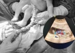 Sản phụ 20 tuổi chuyển dạ, bác sĩ siêu âm giật mình trước hình ảnh bất thường của dây rốn: Mổ lấy thai khẩn cấp!