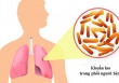 Thủ tướng chỉ đạo tăng cường công tác phòng, chống bệnh Lao