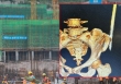 Thêm 1 vụ tai nạn lao động ở công trường xây dựng, nữ công nhân bị thanh sắt rơi trúng, đâm xuyên người