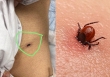 Đi hai bệnh viện, bệnh nhân mới tìm ra nguyên nhân gây suy đa tạng từ vết loét nhỏ trên da
