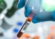 Mỹ phát triển xét nghiệm máu phát hiện sớm ung thư vùng đầu và cổ do HPV