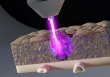 Tia plasma lạnh, 'vũ khí mới' trong điều trị ung thư: diệt khối u ẩn, giảm nguy cơ tái phát