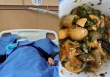 Một gia đình sáu người ăn trứng, 4 người bị ngộ độc và hai người nguy kịch phải chạy thận nhân tạo: Bác sĩ cảnh báo 'Đừng ăn kiểu này'