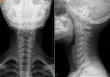 10 tuổi cột sống cổ đã cong vẹo, không cử động được vì thói quen của nhiều người