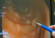 Polyp ở 3 vùng dễ dẫn đến ung thư, 5 thói quen tốt cần làm để tránh