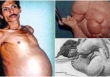 Người đàn ông mang trong mình 'thai chết lưu' suốt 36 năm, bào thai nặng 4kg, có cả tóc và tay chân 