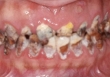 Cô gái mới 22 tuổi cả hàm răng đã đen kịt, ăn đồ mềm cũng rụng răng vì loại đồ uống người trẻ yêu thích