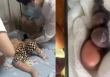 Bé trai 2 tuổi nhiễm vi khuẩn ăn thịt người, phải cắt cụt chi vì nghịch cá ở chợ