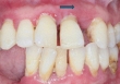 Bác sĩ cảnh báo thói quen nhiều người cứ ăn xong là làm, khiến răng càng ngày càng thưa, thậm chí làm teo nướu