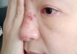 Mở gói hàng đặt qua mạng, người phụ nữ bị nhiễm trùng mắt