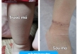 Phú Thọ: Bé gái 16 tháng tuổi có ngấn trên chân, bố mẹ tưởng bụ bẫm nhưng hoá ra lại là dị tật bẩm sinh nguy hiểm