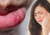 Mẹo hay trị bệnh nhiệt miệng nhanh chóng tại nhà