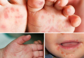 Bệnh tay chân miệng tại TP.HCM tăng gấp 4 lần, cách phòng tránh thế nào?