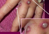 Vaccine có hiệu quả chống lại bệnh đậu mùa khỉ đến 85%