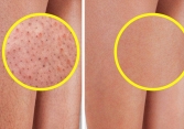 7 mẹo đơn giản hỗ trợ làn da bị viêm nang lông 
