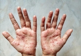 Brazil sử dụng thuốc kháng virus Tecovirimat điều trị bệnh nhân mắc đậu mùa khỉ nặng