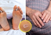 Tại sao nốt ruồi xuất hiện và việc phân loại chúng lại quan trọng