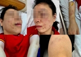 Giám định thương tật người phụ nữ bị chồng cũ 'bắt cóc', đánh đập dã man