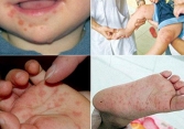 1 trường hợp tử vong nghi do bệnh tay chân miệng, Bộ Y tế khuyến cáo phòng chống bệnh