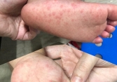 TP.HCM lo thiếu thuốc điều trị tay chân miệng nặng, Bộ Y tế nói gì?