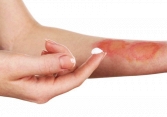 Cách chữa vết bỏng hiệu quả và tránh để lại sẹo