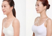 Những nguyên tắc để có một ca nâng ngực 'êm ả'