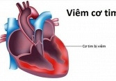 Thực hư virus viêm cơ tim gây chết người đang xôn xao cộng đồng mạng