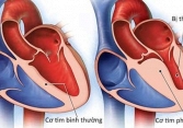 Bộ Y tế bác tin virus lạ viêm cơ tim gây chết nhiều người