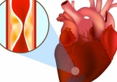 Cảnh báo cho người dưới 35 tuổi: Nhồi máu cơ tim ngày càng trẻ hóa