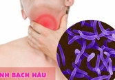 Bé trai mắc bệnh bạch hầu ở Gia Lai đã tử vong