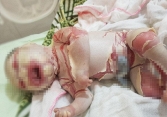 Bé sơ sinh mắc bệnh lạ với lớp vảy trắng bọc toàn thân kèm theo những vết nứt sâu, chảy máu