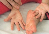 Số ca bệnh tay chân miêng tăng 4 lần so cùng kỳ năm ngoái