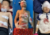 Tuyên Quang: 4 học sinh bị thương nặng khi dùng máy xay sinh tố để trộn hóa chất
