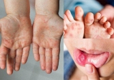  7 trẻ đã tử vong vì tay chân miệng 
