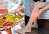 Khi tích tụ nhiều cholesterol nguy hiểm, cơ thể phát ra tín hiệu đầu tiên ở chân, bạn cần đi khám ngay nếu gặp