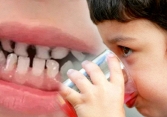 Bé trai 14 tuổi gần như mất cả hàm răng, phải dùng răng giả do nghiện một loại nước nhiều người yêu thích