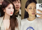 Nữ idol gợi cảm Hyuna phải phẫu thuật, bó bột vì tai nạn không ngờ