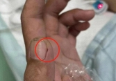 Bị viêm màng não nguy kịch vì cách sơ chế thịt lợn sai nhiều người mắc