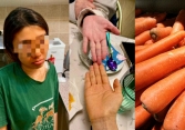 Ăn cà rốt liên tục 3 tháng để giảm cân, cô gái da chuyển vàng như nghệ