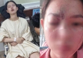 Thiếu nữ 17 tuổi mù mắt vĩnh viễn, liệt nửa não trái sau tiêm filler nâng mũi: Đừng quên 4 điều để an toàn khi làm đẹp