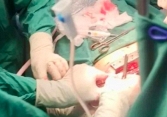 Người phụ nữ đang cắt cành cà phê thì té ngã, bị kéo đâm thủng tim nguy kịch