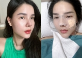 Kỳ Hân - vợ Mạc Hồng Quân khoe mũi sau phẫu thuật thẩm mỹ nhưng dân tình lại khen mũi cũ đẹp hơn